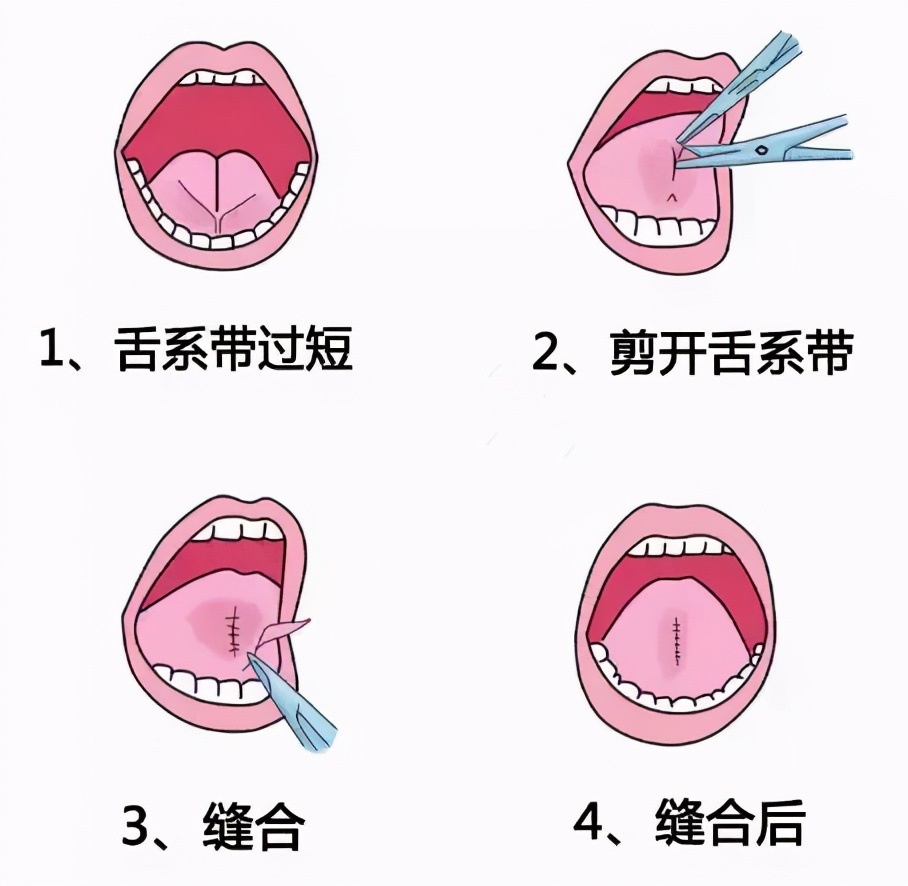 滥用的“剪舌系带”,舌系带到底该不该剪?这一刀孩子挨得很无辜