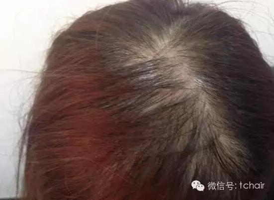 头发分缝处稀疏严重，怎么治疗？