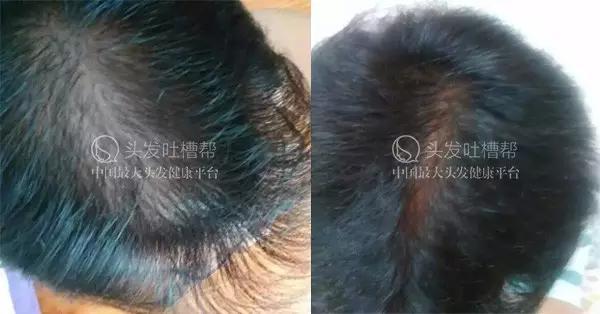 头发分缝处稀疏严重，怎么治疗？