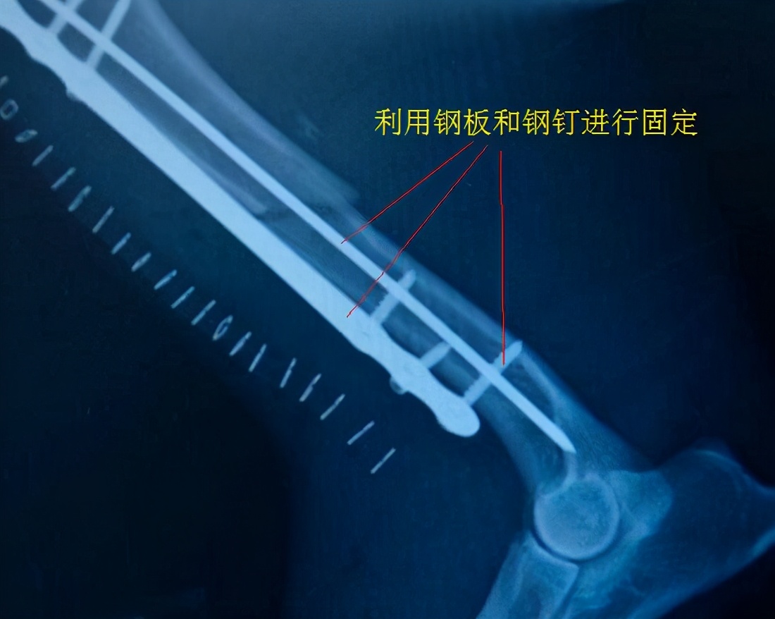 骨折后要不要手术?