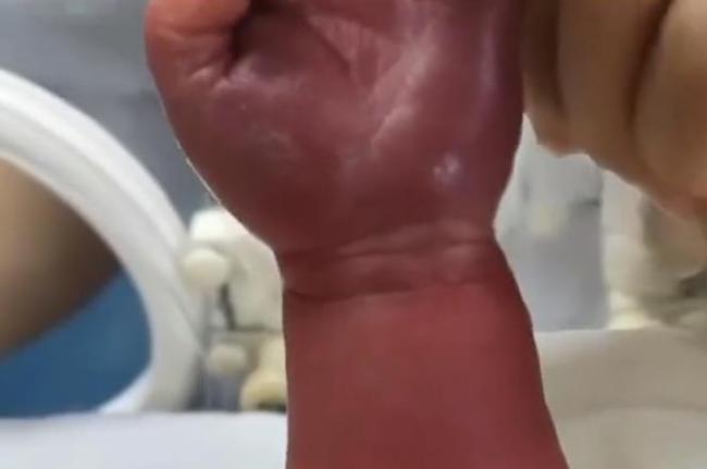 出生一天的婴儿手臂绑皮筋险截肢，真是一位粗心无知的妈妈[捂脸]
