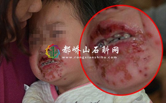 经常吃辣条有什么危害
