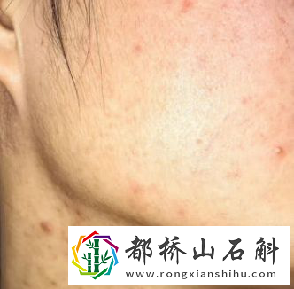 为什么同房后痘痘就消了