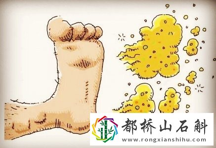 得了脚气就是一辈子吗【脚气一辈子都不能根治吗】
