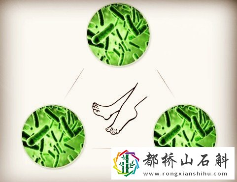 得了脚气就是一辈子吗【脚气一辈子都不能根治吗】