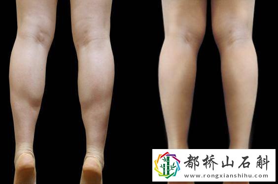 跑步能瘦腿吗会不会越来越粗