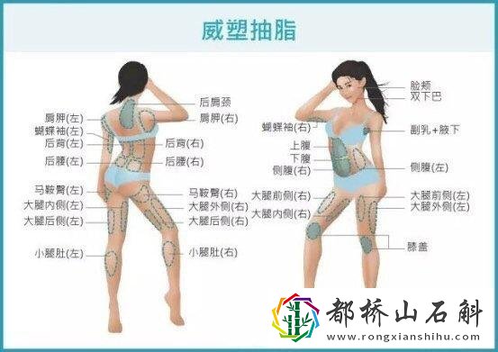 吸脂减肥都有哪些误区
