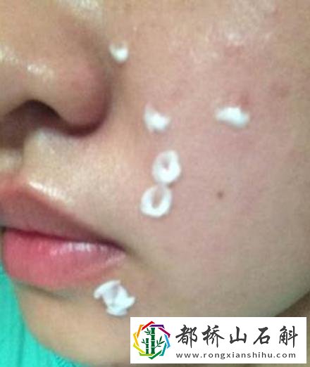 多喝水对痘痘有好处吗