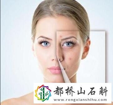多喝水对痘痘有好处吗