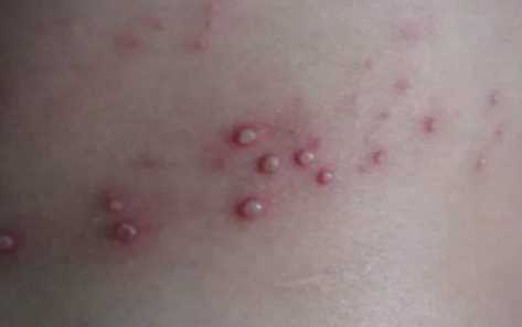 为什么说蛇缠腰是癌症3
