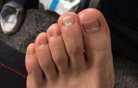 好多人灰指甲都不治正常吗3
