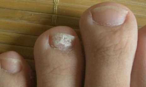 灰指甲是不是越剪越严重3