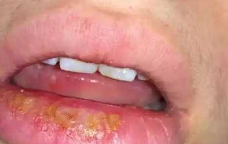 嘴唇疱疹结痂了可以接吻吗2