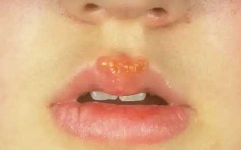 嘴唇起疱疹之后干巴巴的涂抹啥1